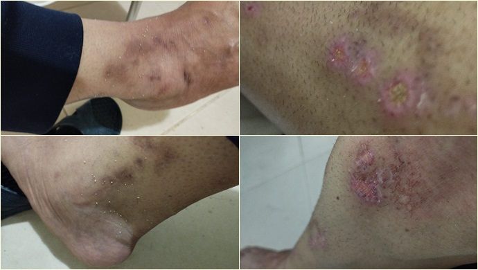 Şanlıurfa’da Uyuz Salgını: Vatandaşlar Endişeli