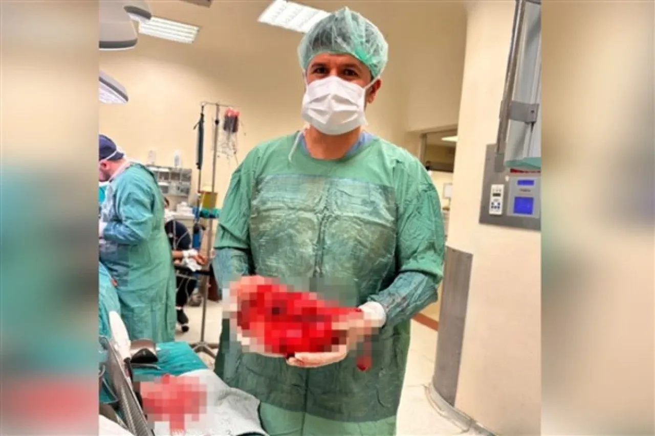 Şanlıurfa’da bir hastanın karnından 5 kilogramlık böbrek tümörü çıkarıldı